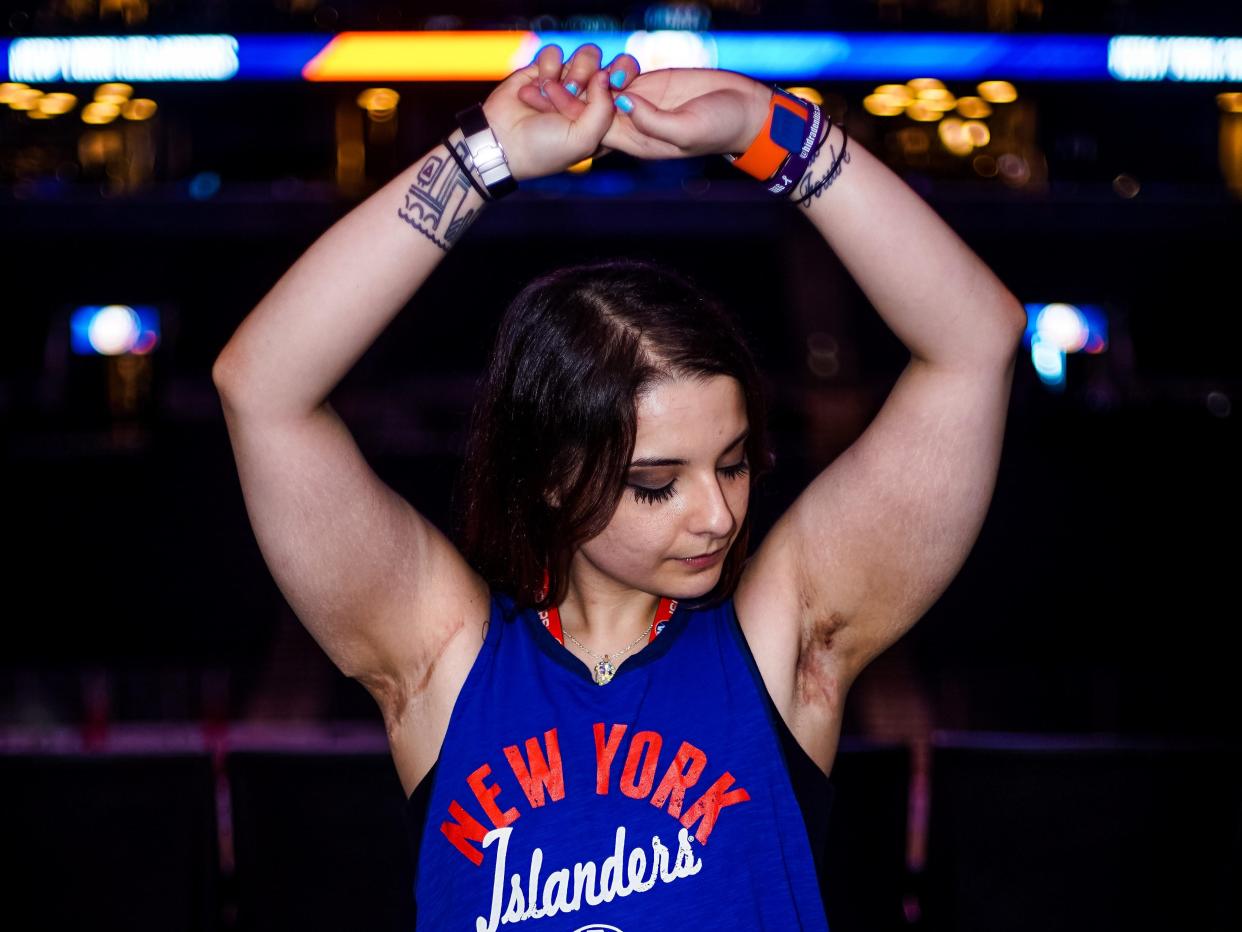 Selina Ferragamo showing her arms after HS surgeries