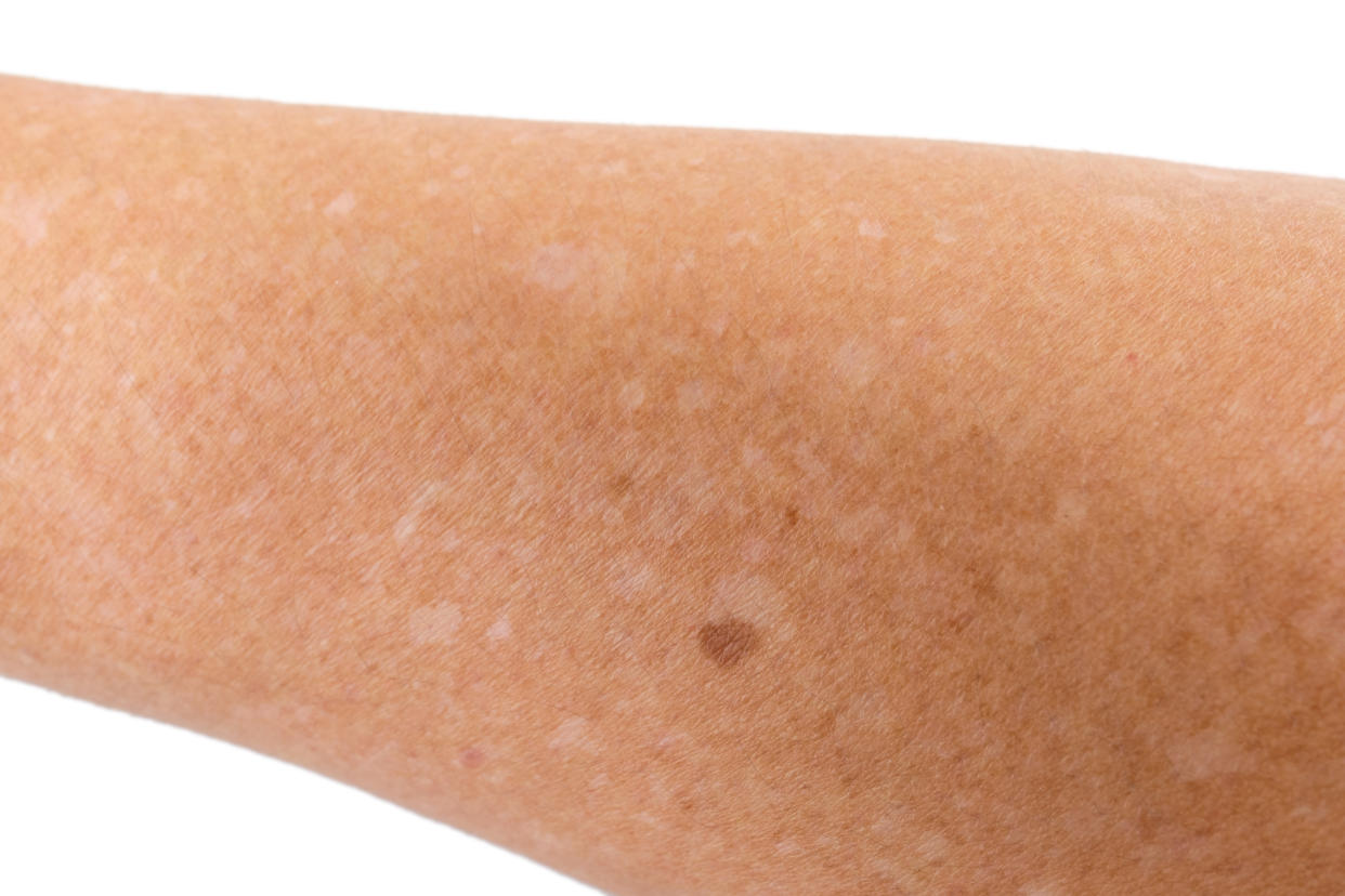 Les taches blanches présentes sur la peau correspondent à une maladie appelée hypomélanose en gouttes idiopathique. [Photo: Getty]