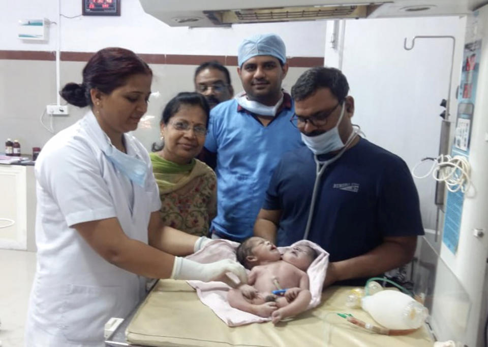 Doctors with the conjoined twins after they were born in India on Saturday (Picture: Caters)