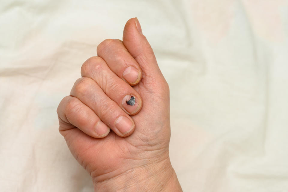 A bruised finger after being hit by a heavy object. A bruise under the nail plate. The hand of an elderly woman