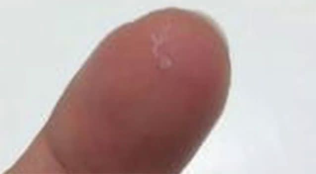 A worm removed from Ms Beckley's eye sits on a fingertip. Source: Centers for Disease Control and Prevention