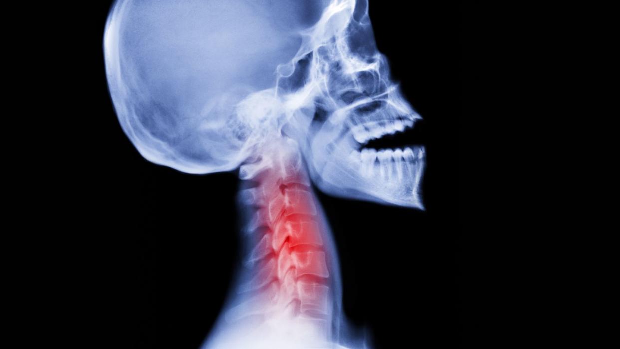 xray of human skull with whiplash