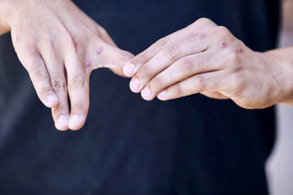 Image: Gerald Febles shows monkepox lesions on his hands on July 3, 2022 in New York. (Benjamin Ryan / NBC News)