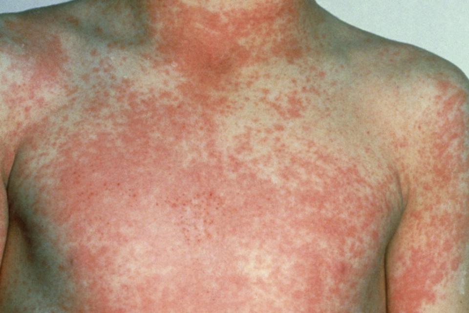 Scarlet fever can cause red rashes on the skin (NHS)