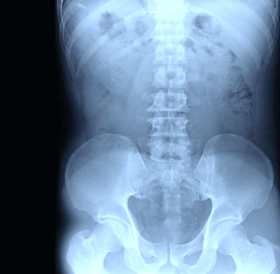 X-ray of hips