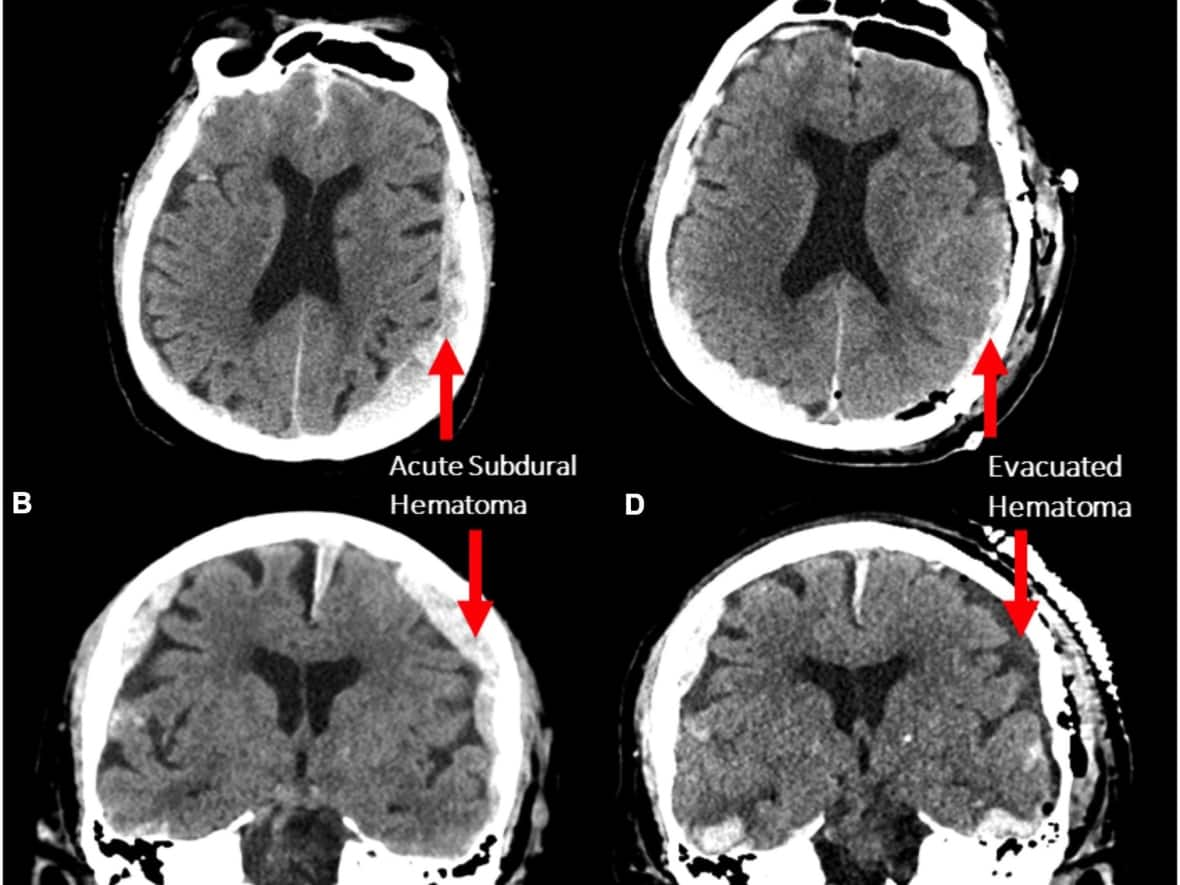 A CT scan of an 87 year-old man operated on in Vancouver General Hospital for a subdural hematoma. His brain activity was recorded by an electroencephalogram (EEG) moments before death, revealing a surge of brain activity 30 seconds after his heart stopped. (Frontiers in Aging Neuroscience - image credit)