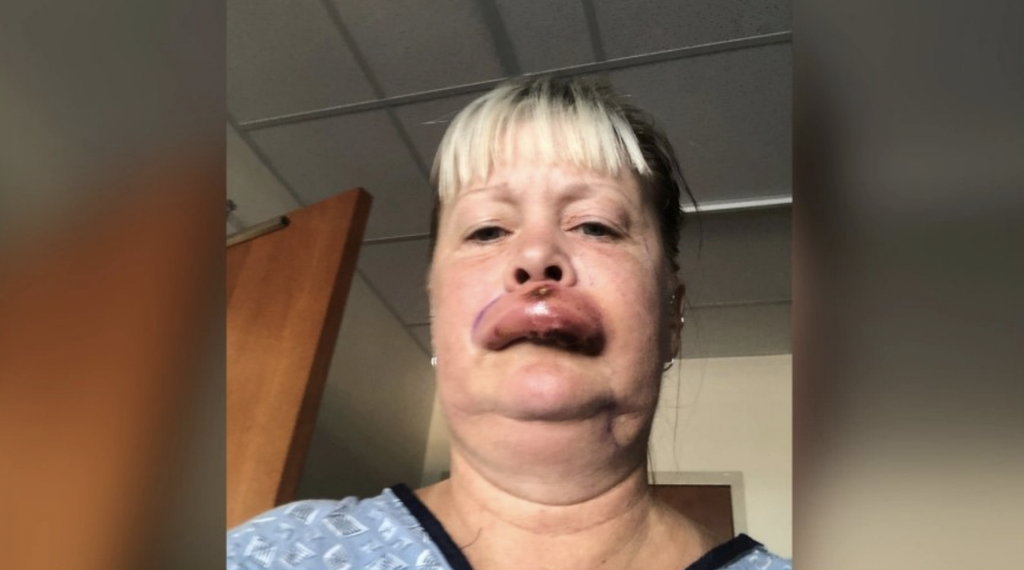 Sherri Maddox was bitten by a brown recluse spider. (Sherri Maddox)