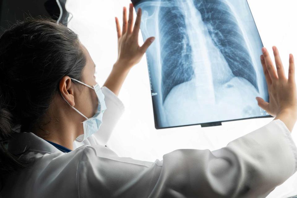 <p>Getty</p> Lung Cancer X-Ray