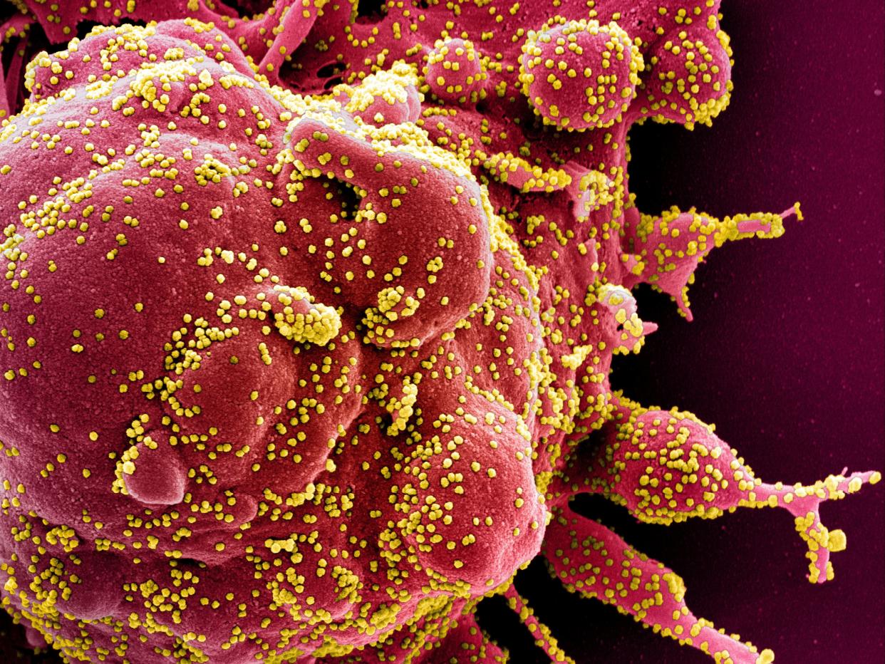 Coloured scanning electron micrograph of an apoptotic cell (red) infected with coronavirus particles (yellow) isolated from a patient sample (NIH/REUTERS)