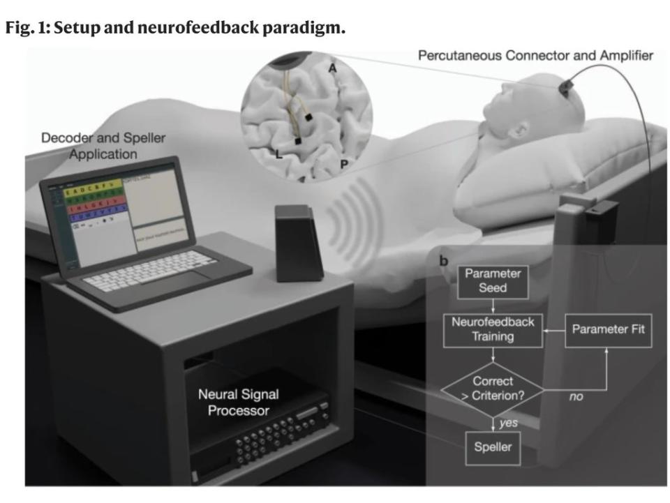 The patient was provided auditory feedback of neural activity levels through a nearby speaker, which allowed them to adjust frequencies to generate ‘yes’ and ‘no’ responses (Wyss Center/ Nature Communications)