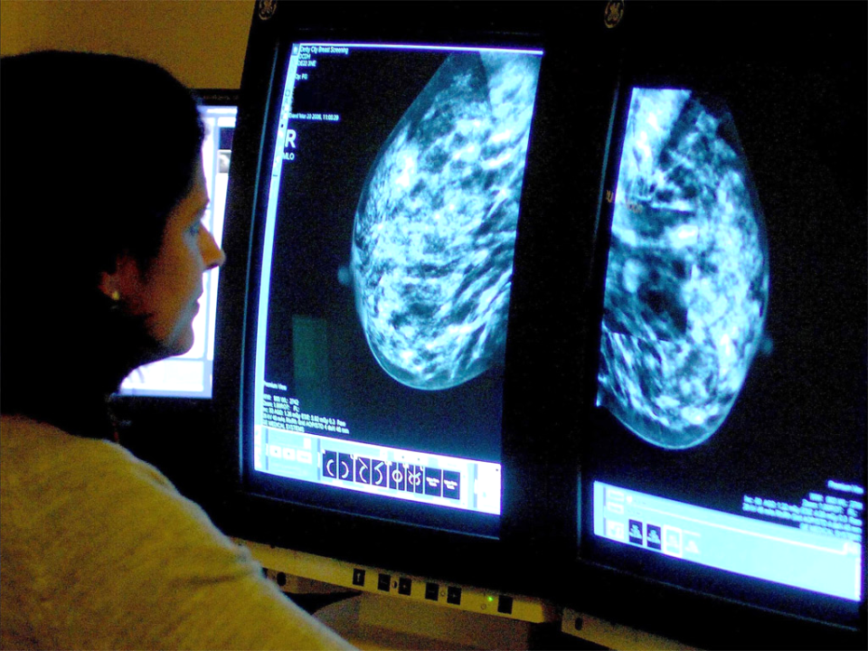 Consultant analyses mammogram of cancer patient (PA)