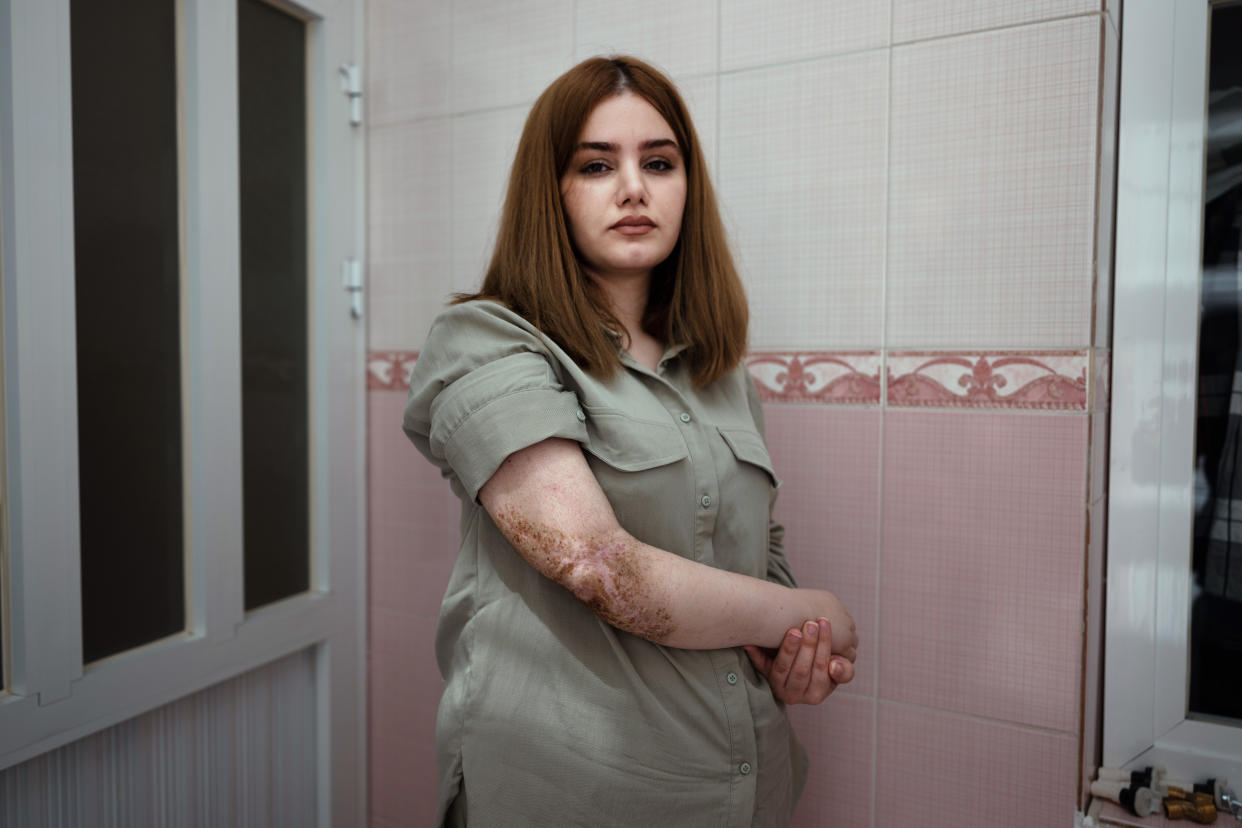 Sima Moradbeigi huyó de Irán con su marido y su hija, con la ayuda de un contrabandista de personas, tras recibir disparos y ser herida de forma grave por las fuerzas de seguridad del Estado. (Emily Garthwaite/The New York Times)

