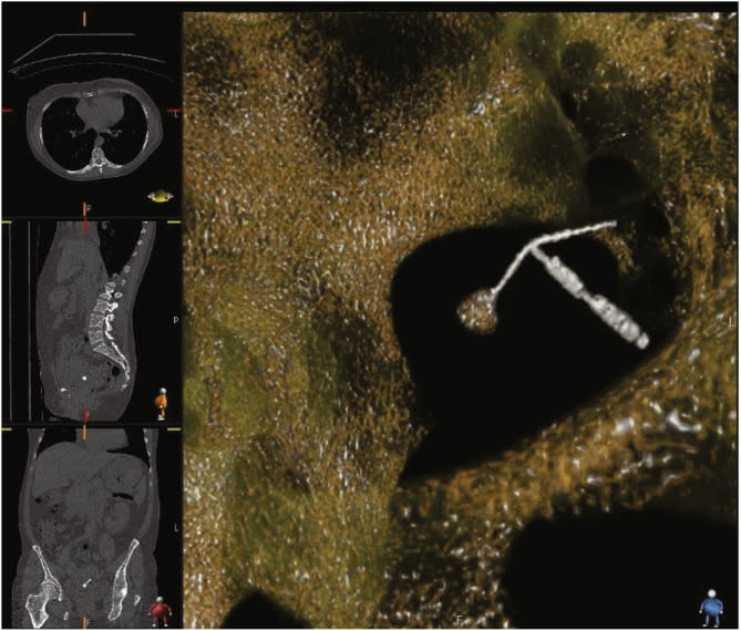 A CT scan shows a T-shaped intrauterine contraceptive copper-bearing device perforating a woman's posterior bladder.