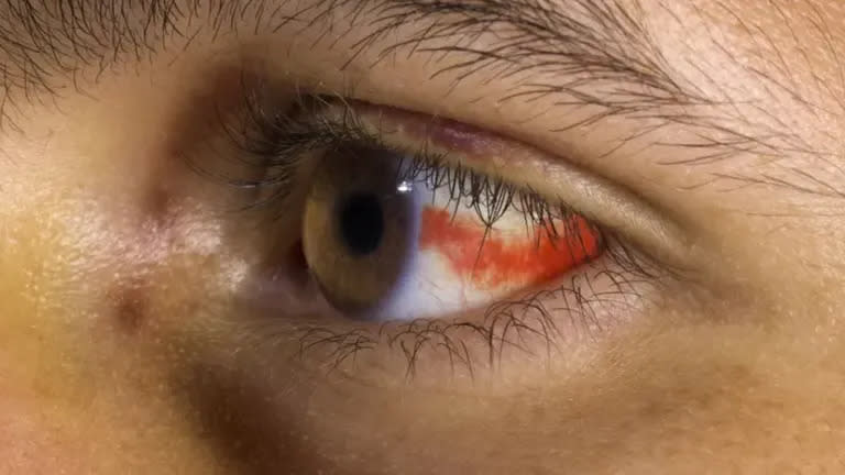 Aunque sea llamativa, las manchas rojas en el ojo pueden ser por un pequeño vaso sanguíneo roto y desaparecen a los días.