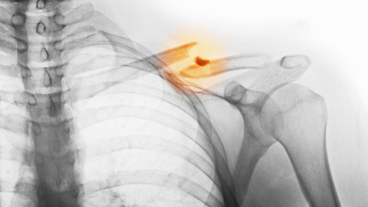 x ray showing fractured clavicle