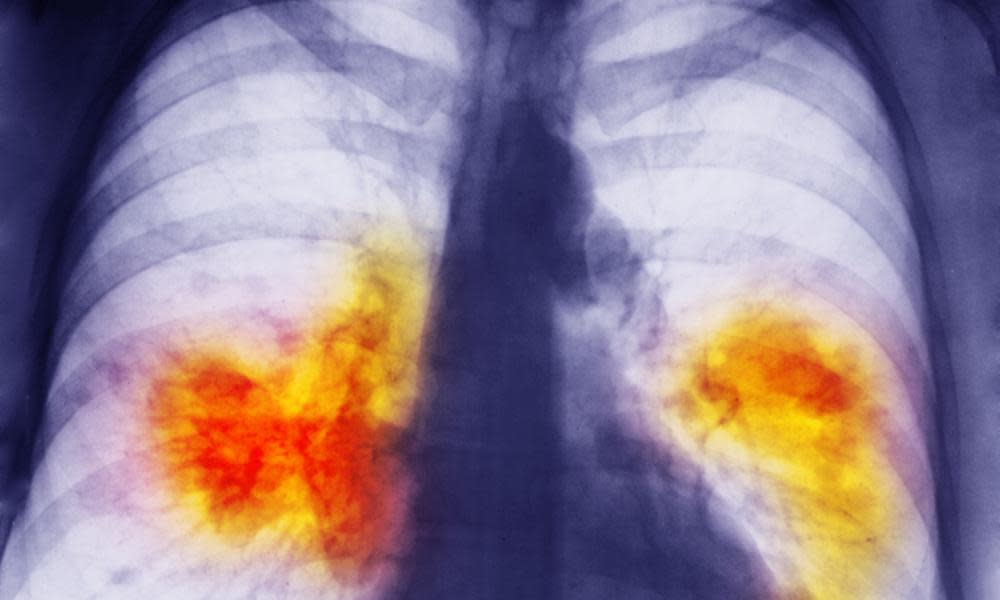 A chest x-ray showing a pair of lungs damaged by cancer