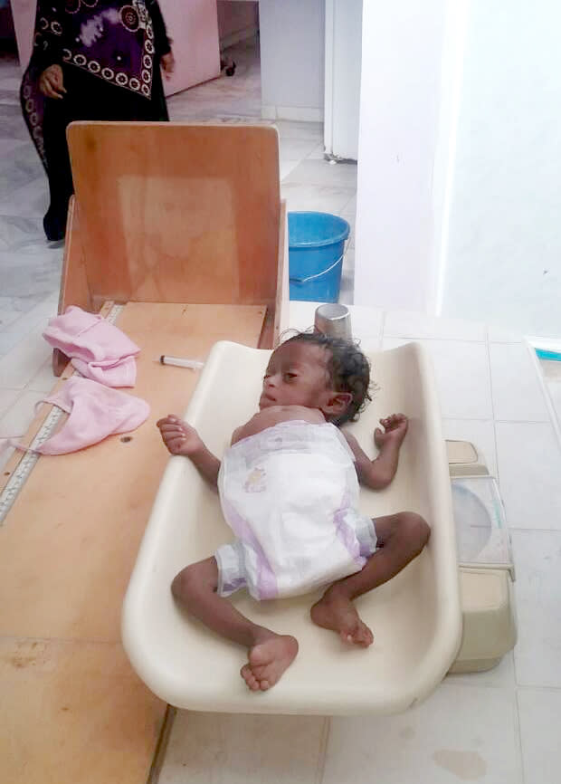 This undated 2018 handout image provided by Dr. Mekkiya Mahdi, Head of Aslam Health Center, shows a severely malnourished infant at the Aslam Health Center in Hajjah, Yemen. The situation in Aslam district is a sign of the holes in an international aid system that is already overwhelmed but is the only thing standing between Yemen’s people and massive death from starvation amid the country’s 3-year civil war. (Courtesy of Dr. Mekkiya Mahdi via AP)