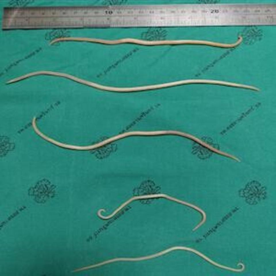 Ascaris worms are pictured after being removed from a man, 68.