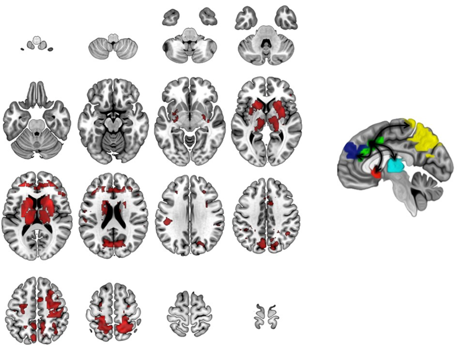 In children with OCD, the brain’s arousal center, the anterior cingulate cortex, is ‘hijacked.’ This causes critical brain networks to stop working properly. <a href="https://www.frontiersin.org/files/Articles/126375/fnhum-09-00149-HTML/image_m/fnhum-09-00149-g001.jpg" rel="nofollow noopener" target="_blank" data-ylk="slk:Image adapted from Diwadkar VA, Burgess A, Hong E, Rix C, Arnold PD, Hanna GL, Rosenberg DR. Dysfunctional activation and brain network profiles in youth with Obsessive-Compulsive Disorder: A focus on the dorsal anterior cingulate during working memory. Frontiers in Human Neuroscience. 2015; 9: 1-11.;elm:context_link;itc:0;sec:content-canvas" class="link ">Image adapted from Diwadkar VA, Burgess A, Hong E, Rix C, Arnold PD, Hanna GL, Rosenberg DR. Dysfunctional activation and brain network profiles in youth with Obsessive-Compulsive Disorder: A focus on the dorsal anterior cingulate during working memory. Frontiers in Human Neuroscience. 2015; 9: 1-11.</a>, <a href="http://creativecommons.org/licenses/by-sa/4.0/" rel="nofollow noopener" target="_blank" data-ylk="slk:CC BY-SA;elm:context_link;itc:0;sec:content-canvas" class="link ">CC BY-SA</a>