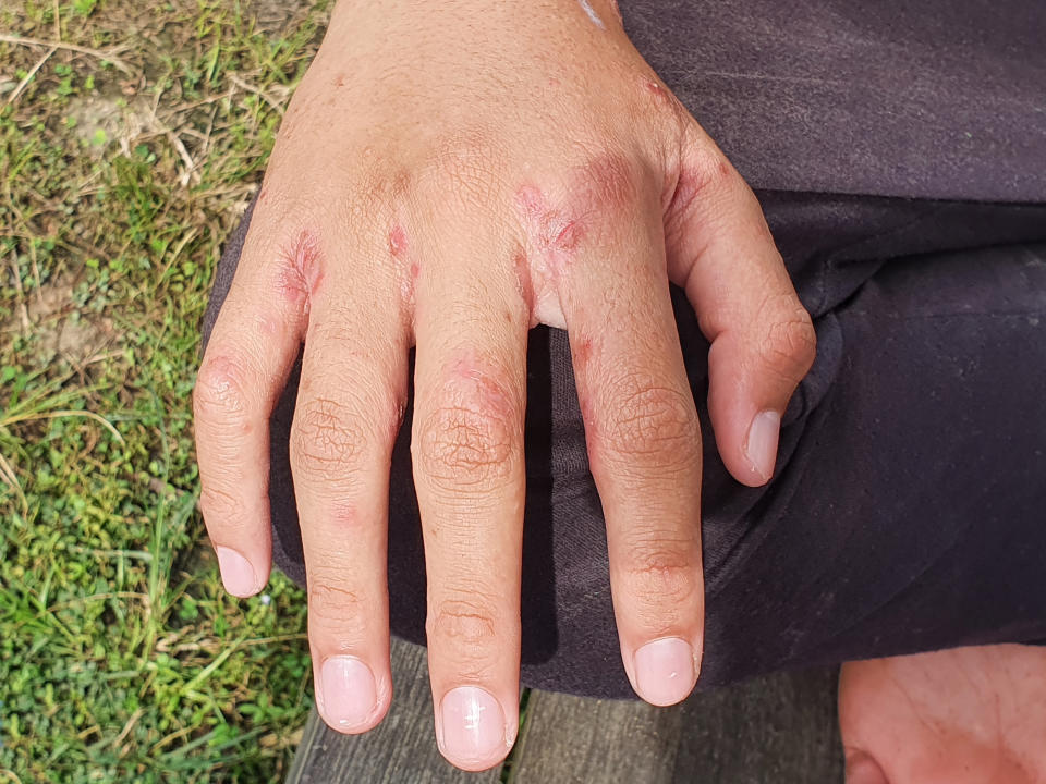 Closeness of hand with pus-filled ulcer caused by scabies infection, sensitive skin itchy health problem