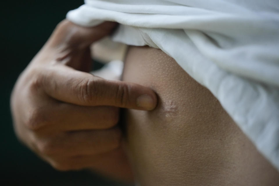 A drug suspect, who uses the alias Lazarus for security, shows a scar from a gunshot wound close to his heart during an interview with the Associated Press at an undisclosed location on the outskirts of Manila, Philippines on June 27, 2022. Lazarus, who was gunned down and left for dead by police officers but surprisingly survived the violence in a dark Metro-Manila alley in 2016, said he still fears for his life but would be willing to testify in the ICC to get justice and possible state reparation. (AP Photo/Aaron Favila)