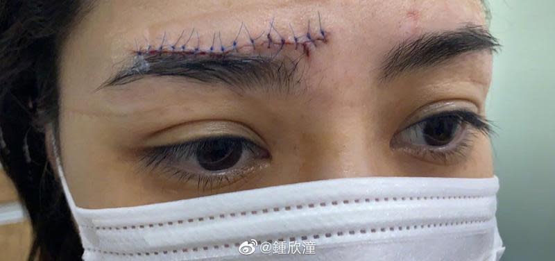 阿嬌曝光受傷後傷口照片，一開始在急診室縫合的傷口痕跡相當驚悚，長度至少有6公分以上。（翻攝自阿嬌微博）