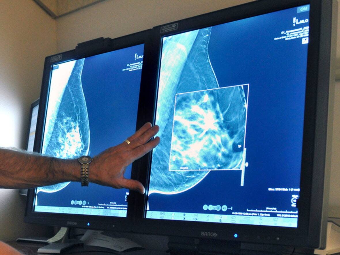 A draft recommendation from the U.S. Preventive Services Task Force calls for women to be screened for breast cancer every two years between the ages of 40 and 74. Previously, screening for average-risk patients was recommended beginning at age 50. (Torin Halsey/Times Record News/The Associated Press - image credit)