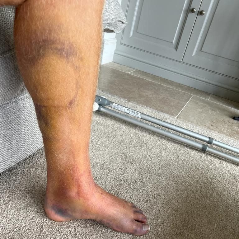 Jonny Bairstow's badly bruised leg - Jonny Bairstow