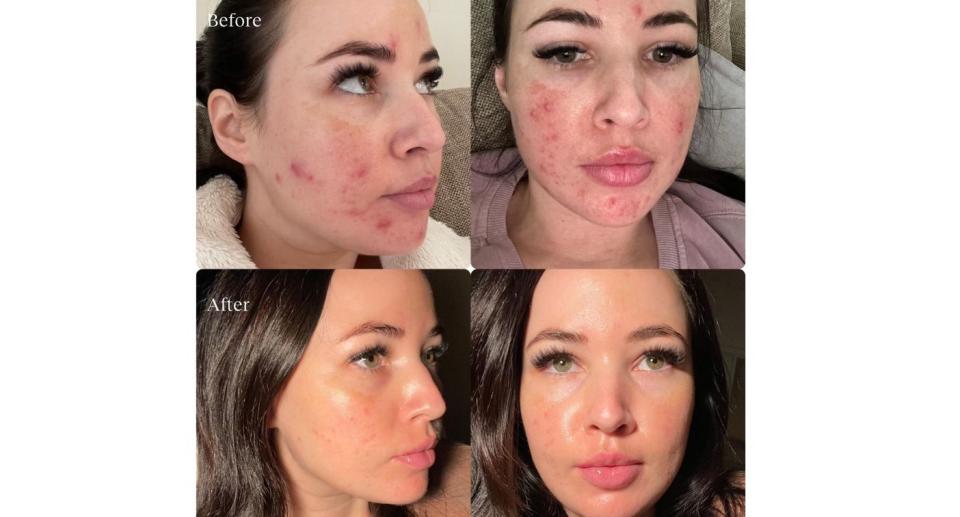 Before and after pictures of woman with acne after treatment at Laser Clinics