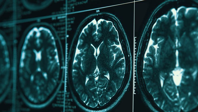 A study is looking at how cerebral spinal fluid draining could be enhanced in older adults and the implications for neurodegenerative diseases.