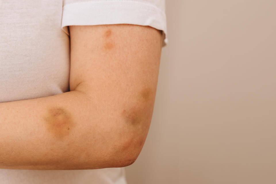 Bruises or hematomas on a woman's arm. Female hand bruised. Domestic violence, abuser.