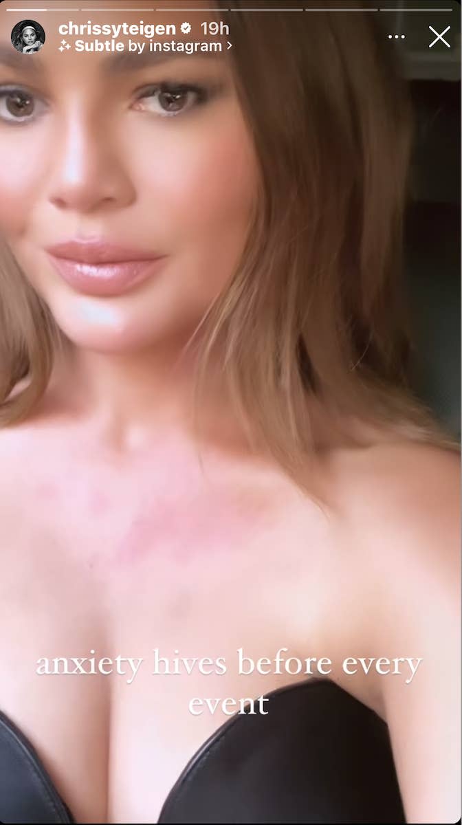 Chrissy Teigen's selfie showing her face and neck with visible hives, captioned "anxiety hives before every event."