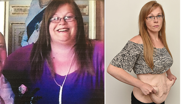 Woman Says Her Excess Skin From Weight Loss Is Worse Than Being Obese 