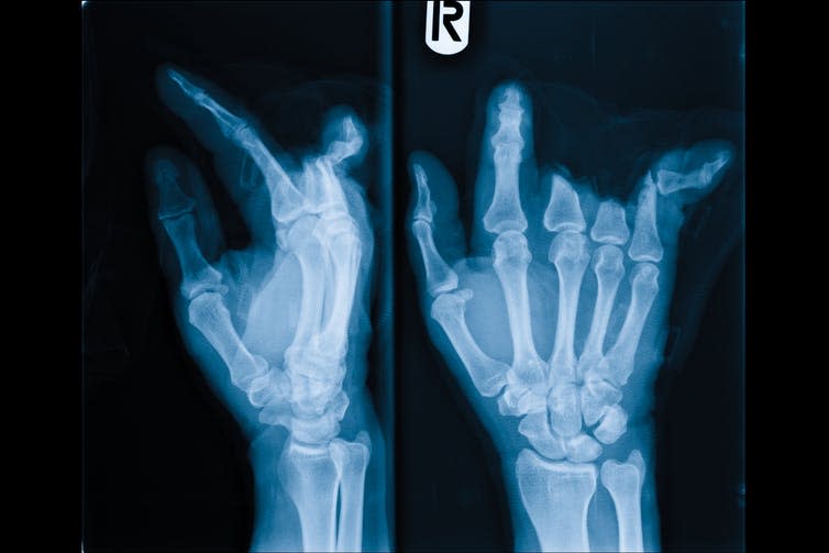 <span class="caption">The brain responds to an anaesthetised and a lost finger in the same way.</span> <span class="attribution"><span class="source">Jarva Jar/Shutterstock</span></span>