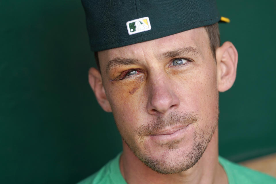 Oakland Athletics pitcher Chris Bassitt speaks to reporters before a baseball game between the Athletics and the New York Yankees in Oakland, Calif., Saturday, Aug. 28, 2021. Bassitt returned to the Bay Area on Friday following facial surgery in Chicago, where he was hit with a line drive the week before. (AP Photo/Jeff Chiu)