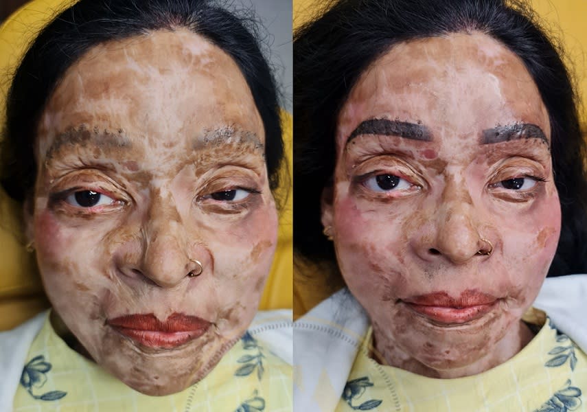 Dr Shikha offers free of cost PMU treatments to acid attack survivors by giving them Permanent Brows, Permanent Lips, Permanent Eyeliner and even Scalp Micropigmentation treatments for free