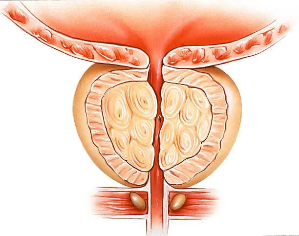 <strong>攝護腺癌的好發年紀較晚，個案多集中在60歲以上男性。（圖／資料庫）</strong>