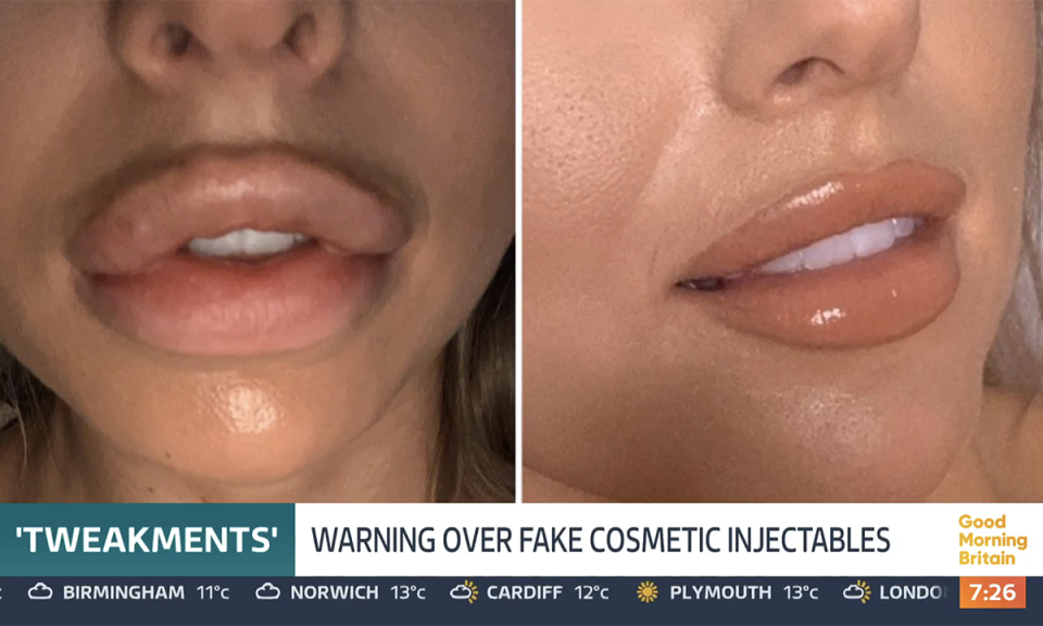 Pictures of Love Island's Faye Winter's lips after lip filler. (ITV screengrab)