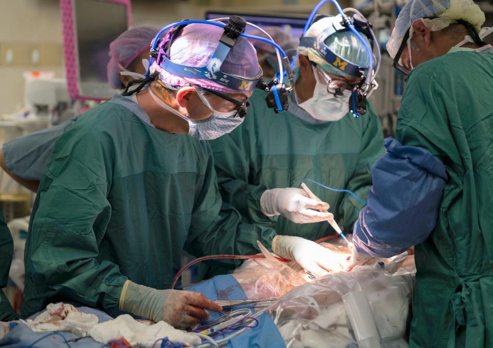 Part of the 10-hour surgery at C.S. Mott Children’s Hospital in Ann Arbor for Sarabeth and Amelia Irwin.