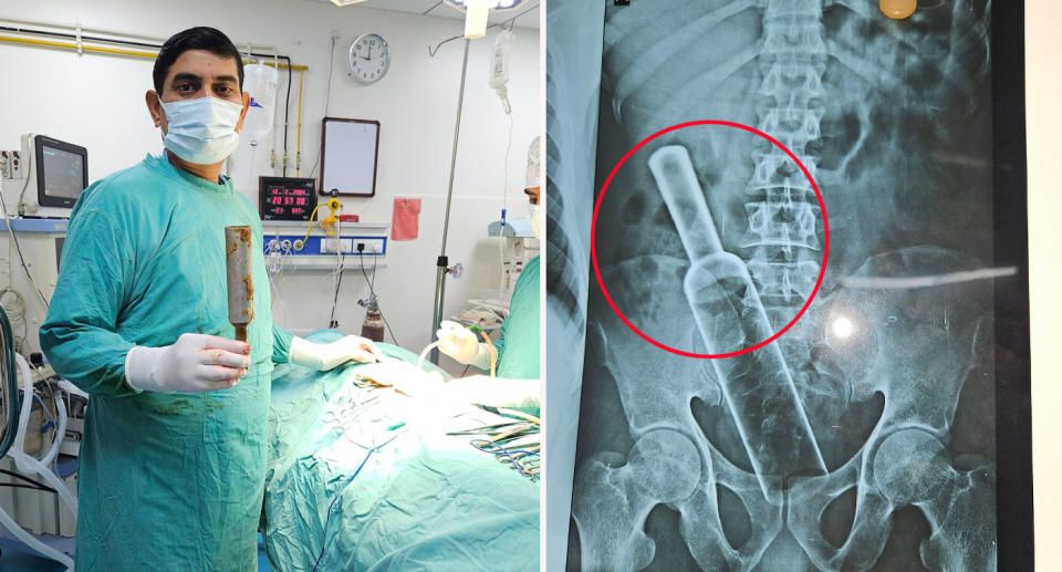 Dr Shiv Shankar Shahi and his team removed the large metal object from the patient's stomach. Source; Jam Press