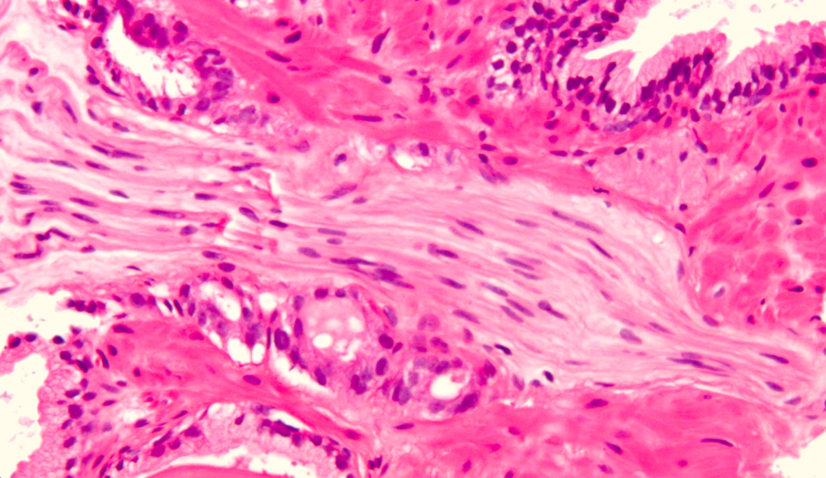 Micrograph of prostatic adenocarcinoma