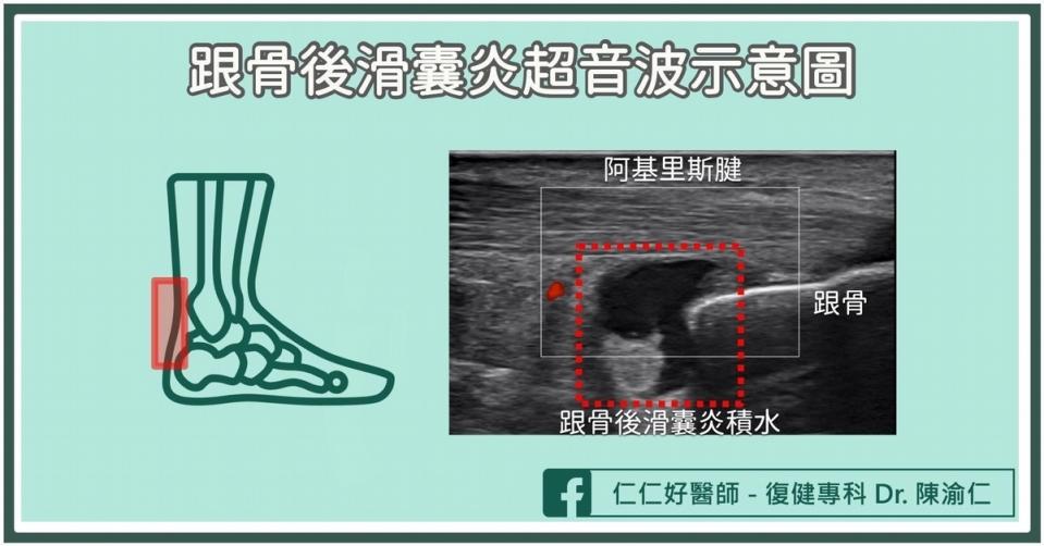 跟骨後滑囊炎的發生原因？