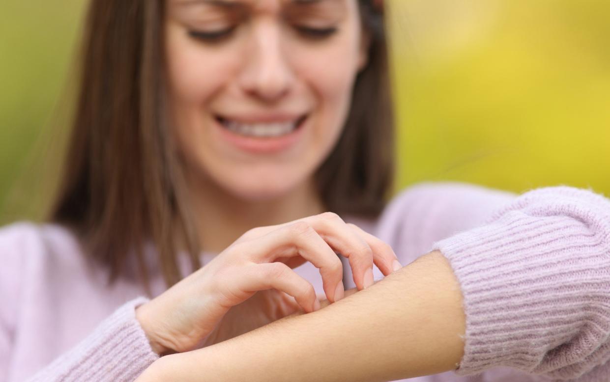 The study is the first time scientists have known that bacteria alone can lead to itchy skin