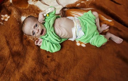 Ali Mohammed al-Tawaari, a six-month-old malnourished boy, lies in a bed at a hospital in Sanaa, Yemen July 28, 2015. REUTERS/Khaled Abdullah