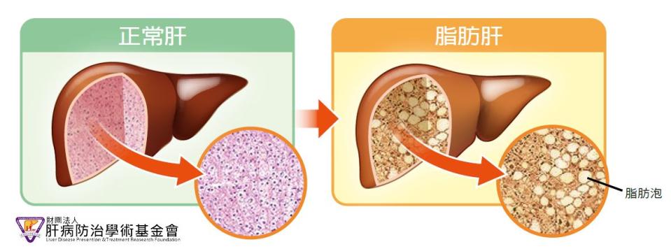 正常肝與脂肪肝的差別