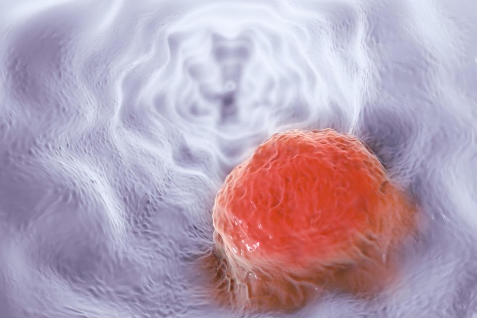 Oesophageal cancer, computer illustration.