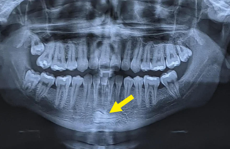 X-ray with an arrow pointing to a tooth in someone's chin