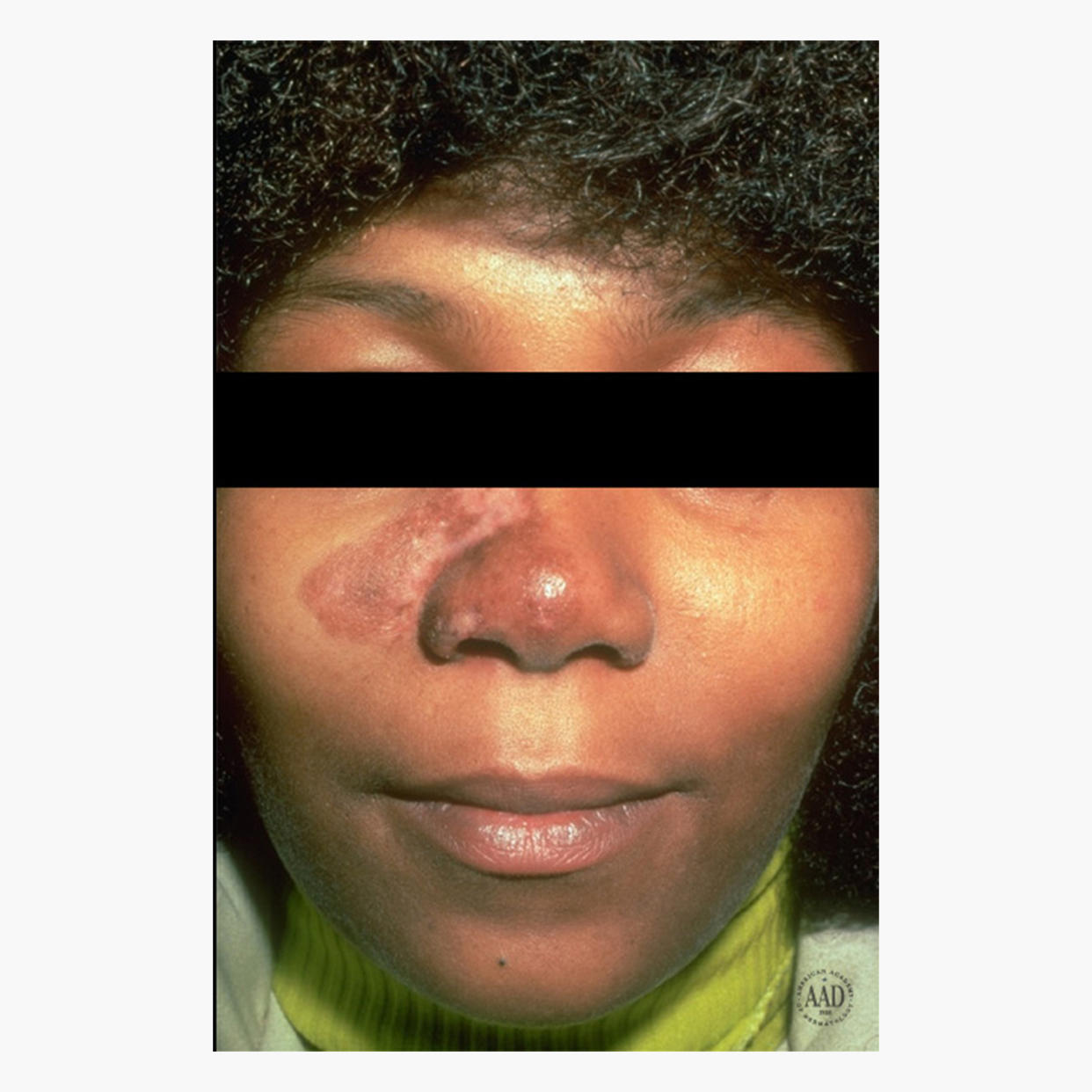 African American woman with lupus skin condition and how to treat lupus (American Academy of Dermatology National Library of Dermatologic Teaching Slides)