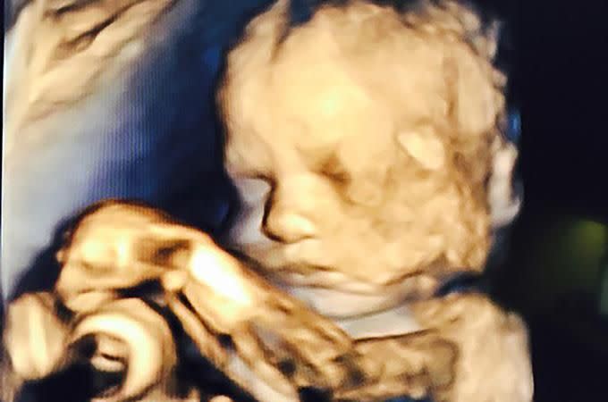 An ultrasound of Rylee. Photo: Caters News