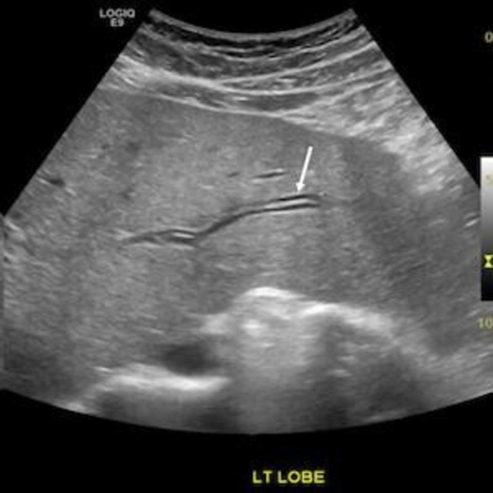 Ultrasonography of hepatobiliary showing a tubular-shaped hypoechoic lesion filling in a common bile duct and a left hepatic bile duct.